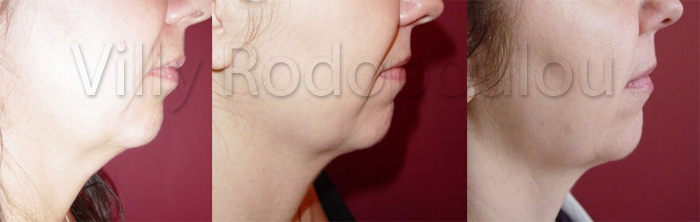 lipodialisi-1